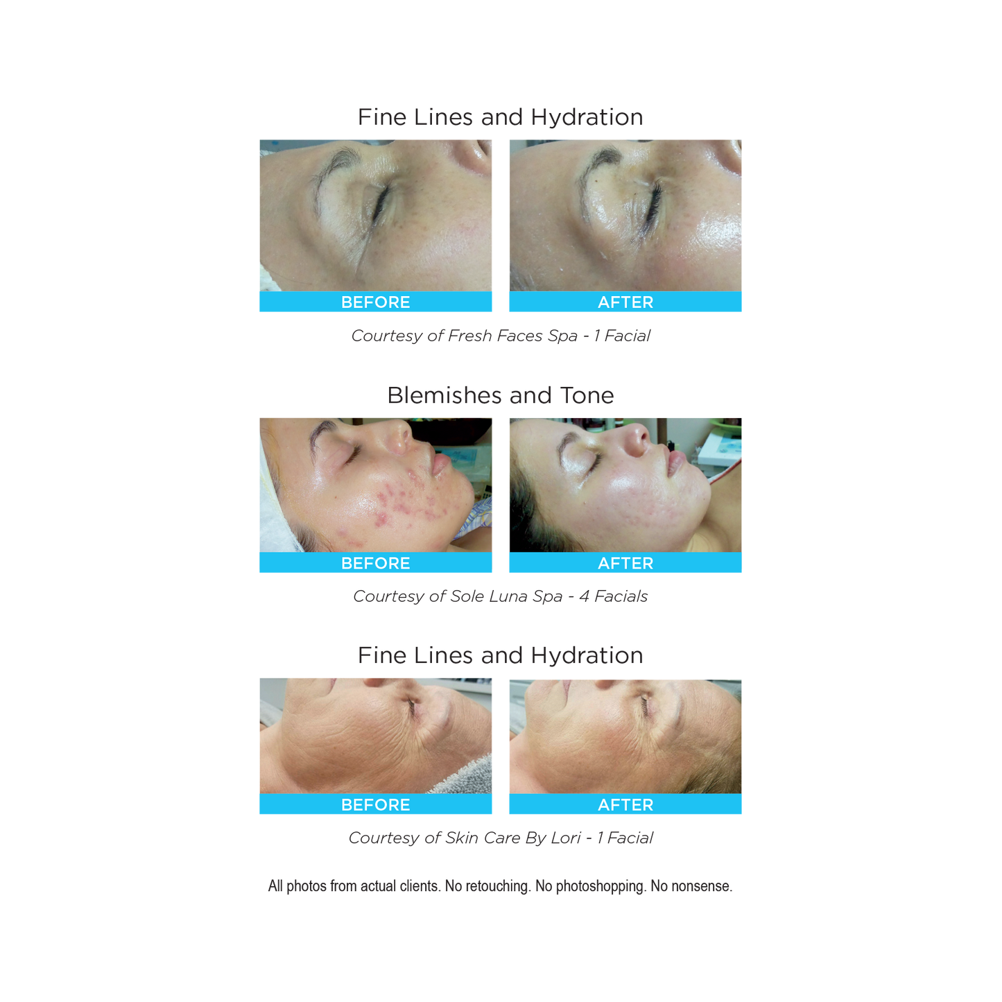 Rezenerate NanoFacial Starter Package