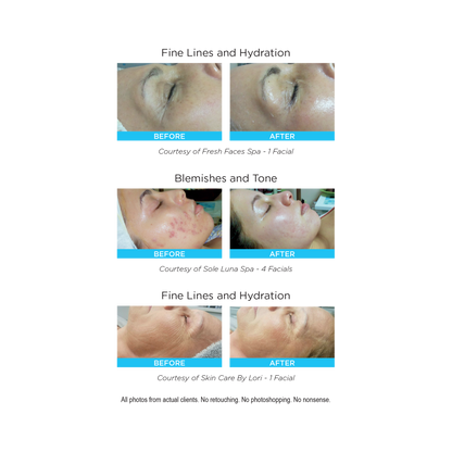 Rezenerate NanoFacial Starter Package